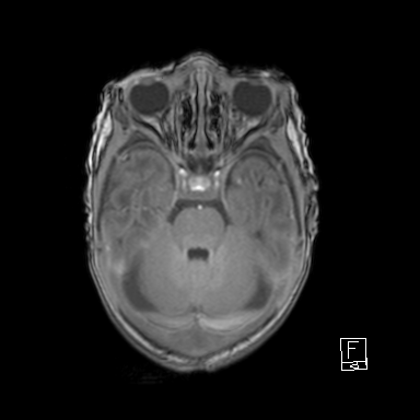 File:Bilateral subdural hemorrhage and parietal skull fracture (Radiopaedia 26058-26190 Axial T1 15).png