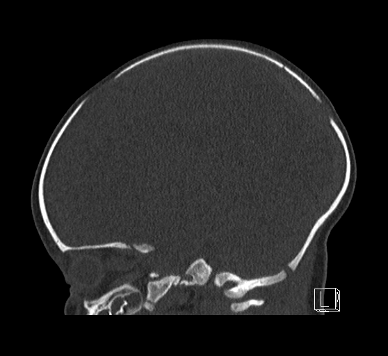 File:Bilateral subdural hemorrhage and parietal skull fracture (Radiopaedia 26058-26192 Sagittal bone window 37).png