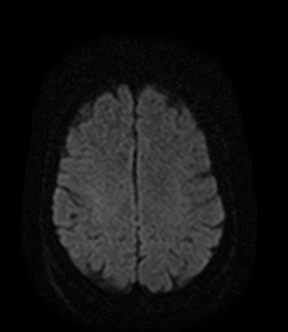 File:Bilateral thalamic glioma (Radiopaedia 65852-75009 Axial DWI 15).jpg
