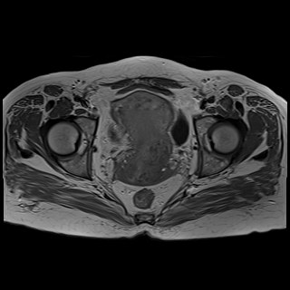 Bilateral tubo-ovarian abscesses (Radiopaedia 58635-65829 Axial T1 C+ 34).jpg