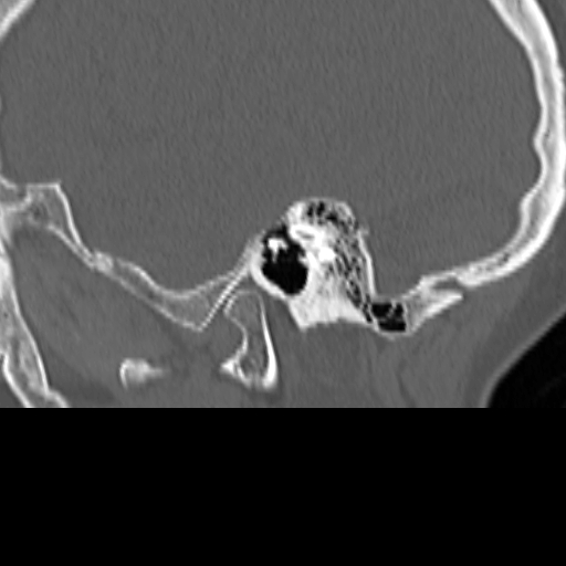 Bilateral tympanoplasty (Radiopaedia 16947-16664 Sagittal bone window 18).jpg