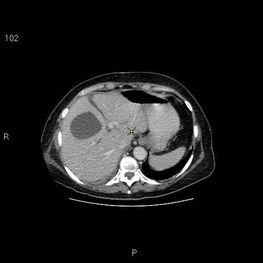 File:Biloma with drainage into the colon (Radiopaedia 20032-20068 A 12).jpg
