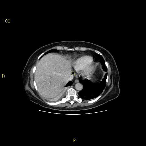File:Biloma with drainage into the colon (Radiopaedia 20032-20068 A 14).jpg