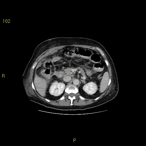 File:Biloma with drainage into the colon (Radiopaedia 20032-20068 A 4).jpg