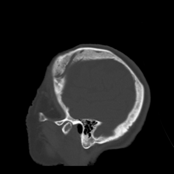 Biparietal osteodystrophy (Radiopaedia 46109-50463 Sagittal bone window 17).jpg