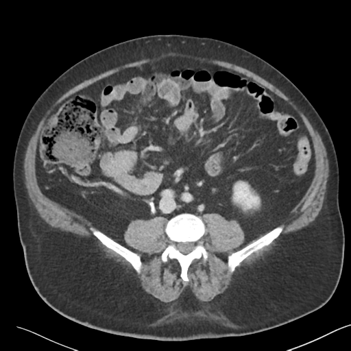 File:Bladder papillary urothelial carcinoma (Radiopaedia 48119-52951 Axial 32).png