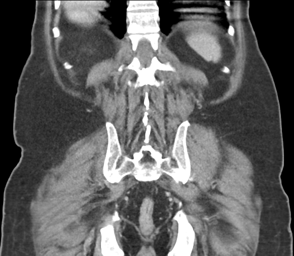 Bladder papillary urothelial carcinoma (Radiopaedia 48119-52951 C 52).png