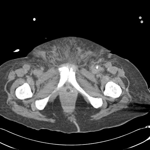 Bladder rupture post renal biopsy (Radiopaedia 30863-31572 Axial non-contrast 90).jpg