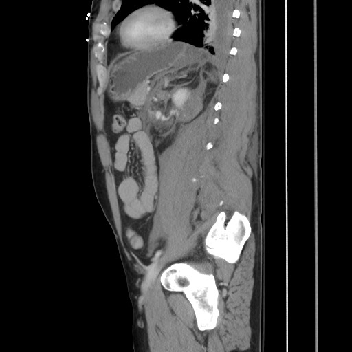 File:Blunt abdominal trauma with solid organ and musculoskelatal injury with active extravasation (Radiopaedia 68364-77895 C 97).jpg