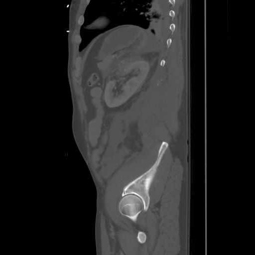 Blunt abdominal trauma with solid organ and musculoskelatal injury with active extravasation (Radiopaedia 68364-77895 Sagittal bone window 83).jpg