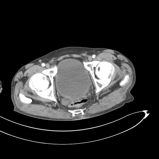 Bone metastasis from squamous cell carcinoma (Radiopaedia 30133-30730 B 74).jpg