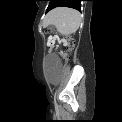 File:Borderline mucinous tumor (ovary) (Radiopaedia 78228-90808 B 20).jpg