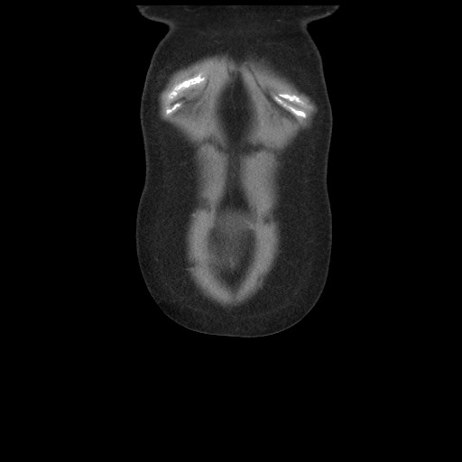 Borderline mucinous tumor (ovary) (Radiopaedia 78228-90808 C 7).jpg