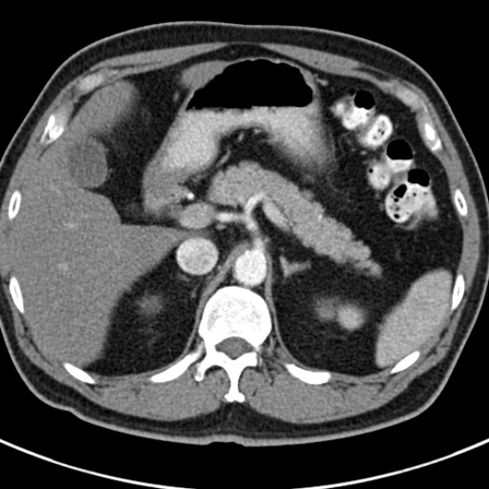 File:Bosniak cyst - type IV (Radiopaedia 23525-23627 renal cortical phase 8).jpg