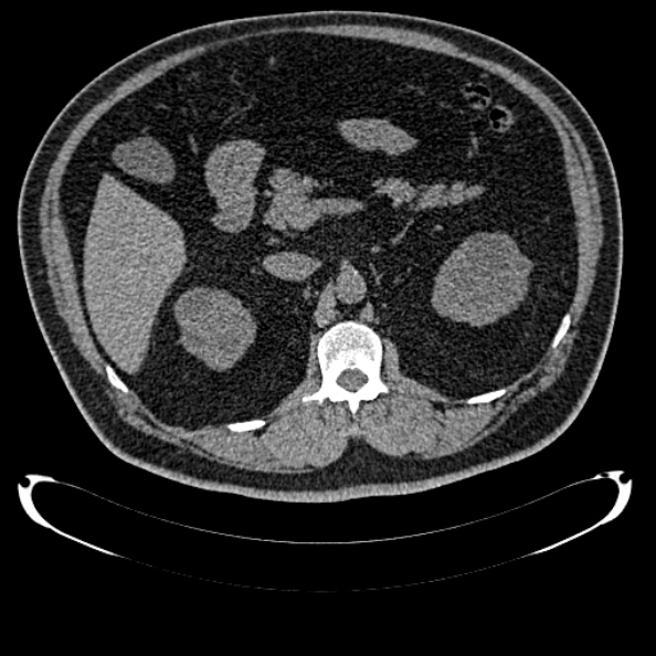 Bosniak renal cyst - type IV (Radiopaedia 24244-24518 Axial non-contrast 129).jpg