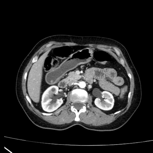 Bosniak renal cyst - type I (Radiopaedia 27479-27675 renal cortical phase 30).jpg