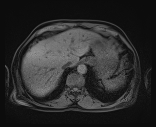 Bouveret syndrome (Radiopaedia 61017-68856 Axial T1 fat sat 14).jpg