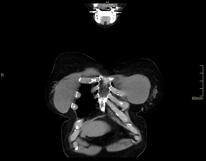 Brachial artery foreign body (Radiopaedia 54583-60820 Coronal non-contrast 4).jpg