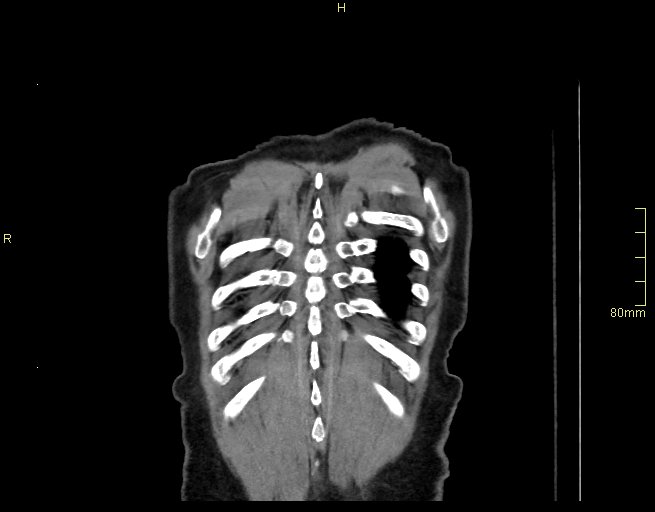Brachial artery foreign body (Radiopaedia 54583-60820 Coronal non-contrast 57).jpg
