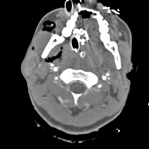 Brain contusions, internal carotid artery dissection and base of skull fracture (Radiopaedia 34089-35339 D 60).png