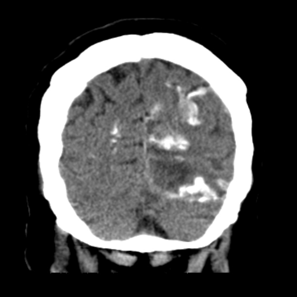 Brain cortical laminar necrosis (Radiopaedia 25822-25971 C 46).jpg