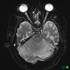 File:Brain death on MRI and CT angiography (Radiopaedia 42560-45689 Axial ADC 12).jpg