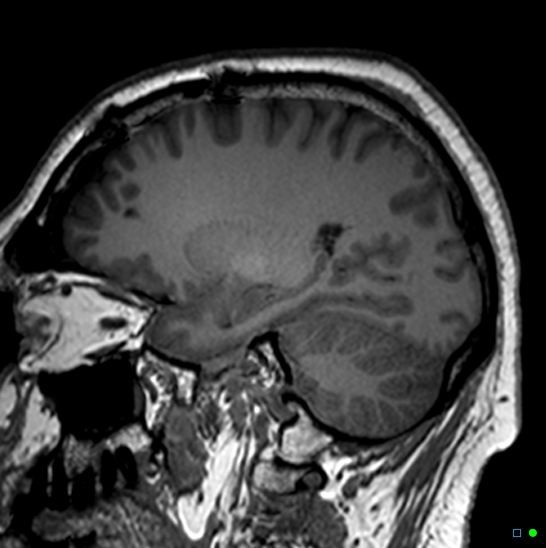 Brain death on MRI and CT angiography (Radiopaedia 42560-45689 Sagittal T1 49).jpg