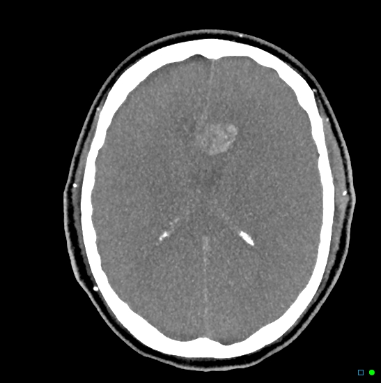 Brain death on MRI and CT angiography (Radiopaedia 42560-45841 B 23).jpg