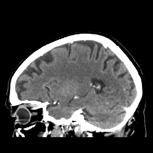 Brain metastasis (Radiopaedia 42617-45760 D 15).jpg