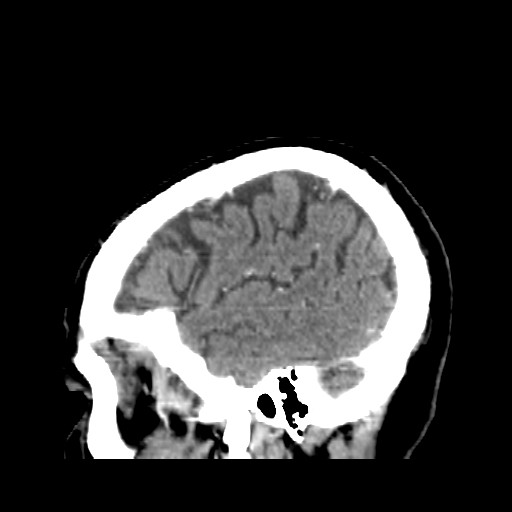 Brain metastasis (Radiopaedia 42617-45760 D 5).jpg