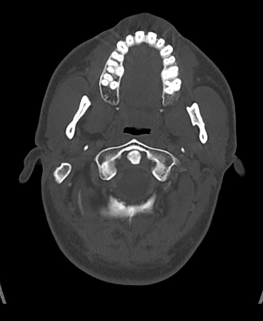 Branchial cleft cyst (Radiopaedia 31167-31875 Axial bone window 17).jpg