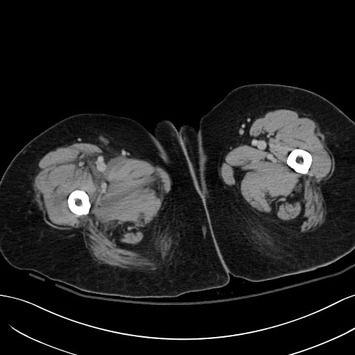 Breast carcinoma with pathological hip fracture (Radiopaedia 60314-67974 B 86).jpg