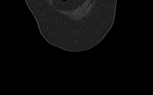 Breast carcinoma with pathological hip fracture (Radiopaedia 60314-67993 Coronal bone window 24).jpg