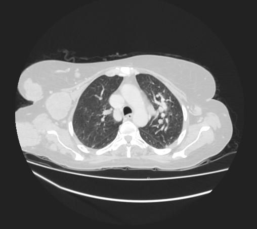 Breast metastases from facial malignant melanoma (Radiopaedia 60316-67975 Axial lung window 30).jpg