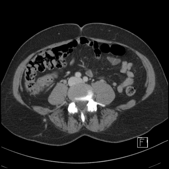 File:Breast metastases from renal cell cancer (Radiopaedia 79220-92225 C 67).jpg