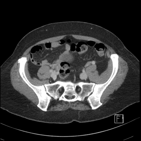 File:Breast metastases from renal cell cancer (Radiopaedia 79220-92225 C 85).jpg
