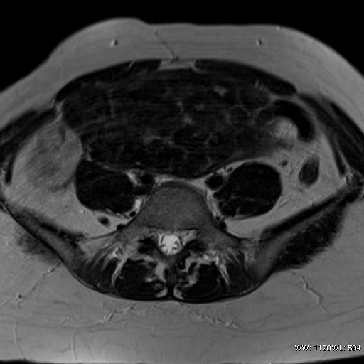 File:Broad ligament fibroid (Radiopaedia 49135-54241 Axial T2 7).jpg