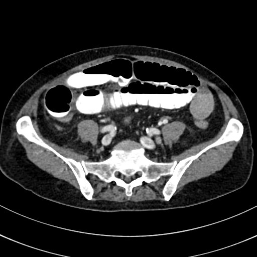 File:Broad ligament hernia (Radiopaedia 84802-100276 A 65).jpg