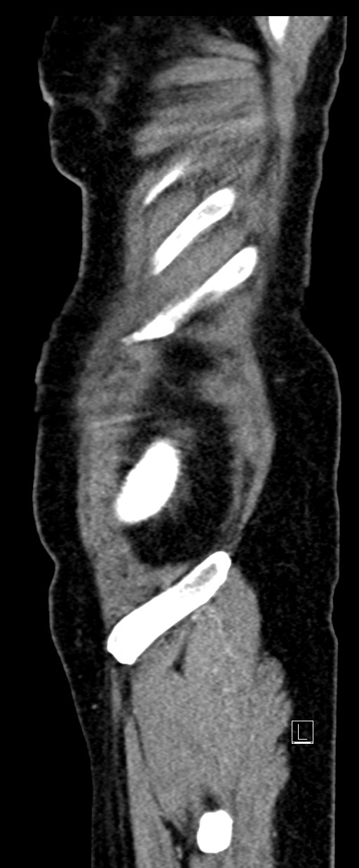Broad ligament hernia (Radiopaedia 84802-100276 C 79).jpg