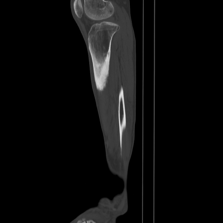 Brodie abscess - tibia (Radiopaedia 66028-75204 Sagittal bone window 56).jpg
