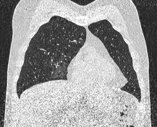 File:Bronchial atresia (Radiopaedia 58271-65417 Coronal lung window 13).jpg
