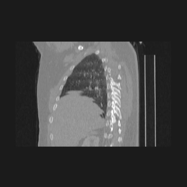 Bronchial atresia (Radiopaedia 60685-68439 Sagittal lung window 22).jpg