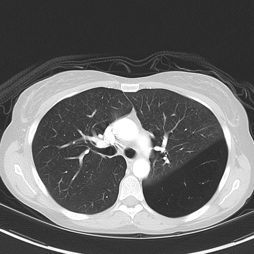 Bronchial atresia (Radiopaedia 73677-84470 Axial lung window 25).jpg