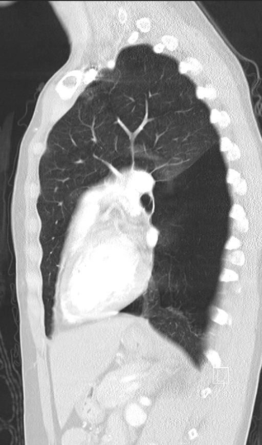 Bronchial atresia (Radiopaedia 73677-84470 Sagittal lung window 33).jpg