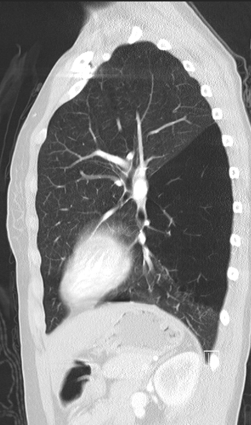 Bronchial atresia (Radiopaedia 73677-84470 Sagittal lung window 36).jpg