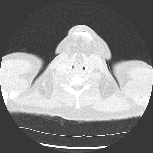 Bronchial carcinoid tumor (Radiopaedia 67377-76764 Axial lung window 1).jpg