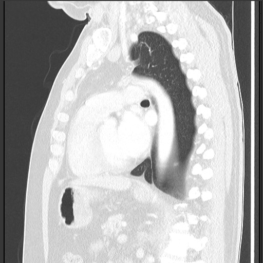 Bronchial carcinoid tumor (Radiopaedia 67377-76764 Sagittal lung window 41).jpg