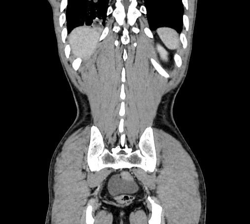 Bronchiectasis in Crohn disease (Radiopaedia 60311-67977 C 75).jpg