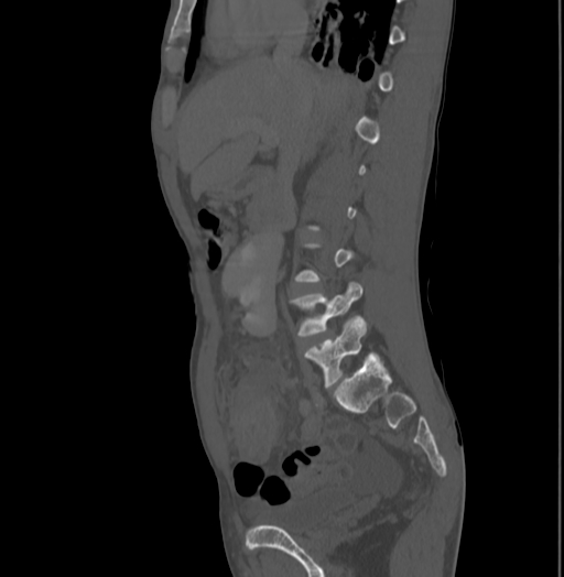 Bronchiectasis in Crohn disease (Radiopaedia 60311-67977 Sagittal bone window 92).jpg