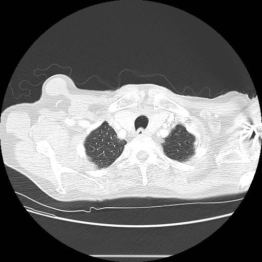Bronchocele (Radiopaedia 17097-16795 Axial lung window 13).jpg